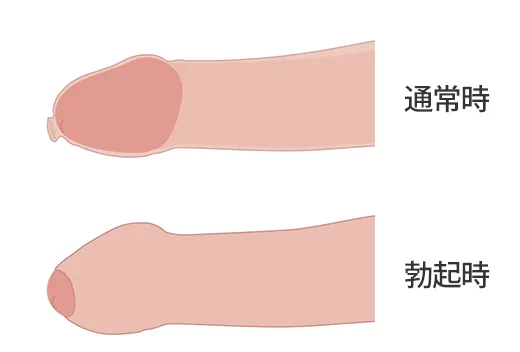 真性包茎の通常時と勃起時