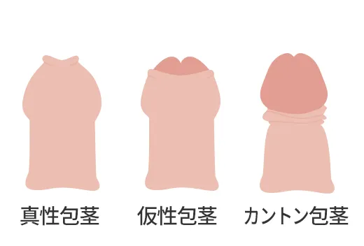 包茎の種類